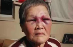 Třiaosmdesátiletá Xiao Zhen Xie po rasově motivovaném útoku.
