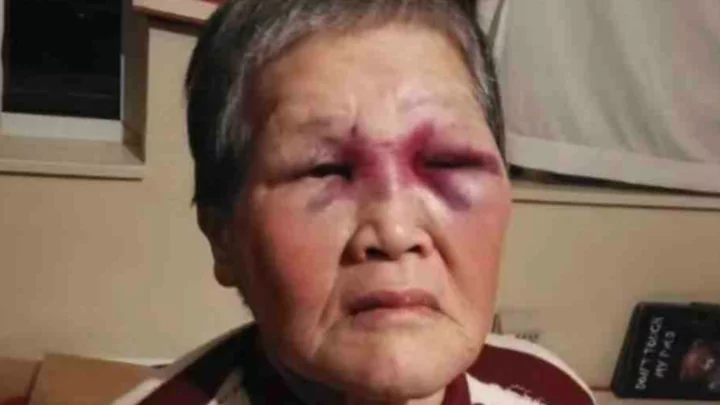 Třiaosmdesátiletá Xiao Zhen Xie po rasově motivovaném útoku.